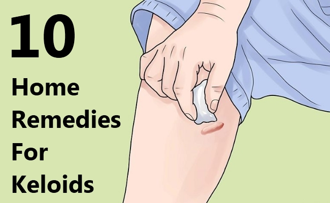 10 Effective Home Remedies For Keloids