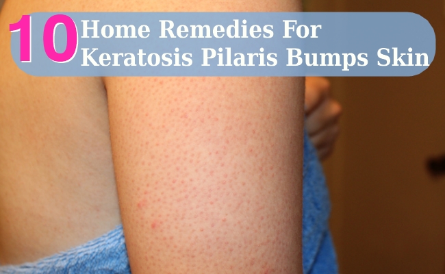 Home Remedies For Keratosis Pilaris Bumps Skin